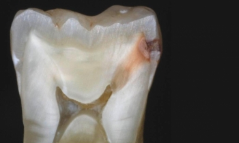 La carie dentaria: la storia, le cause, i rimedi e i consigli