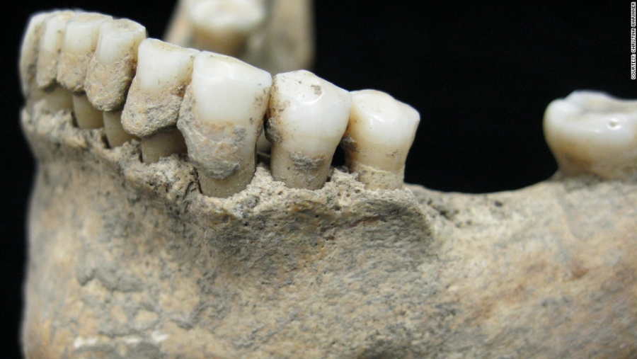 Informazioni e suggerimenti per evitare i danni da placca: dagli antichi masticatori all’efficacia clinica degli oli essenziali